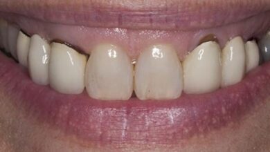 آیا روکش های PFM باعث سیاهی لثه می شوند؟