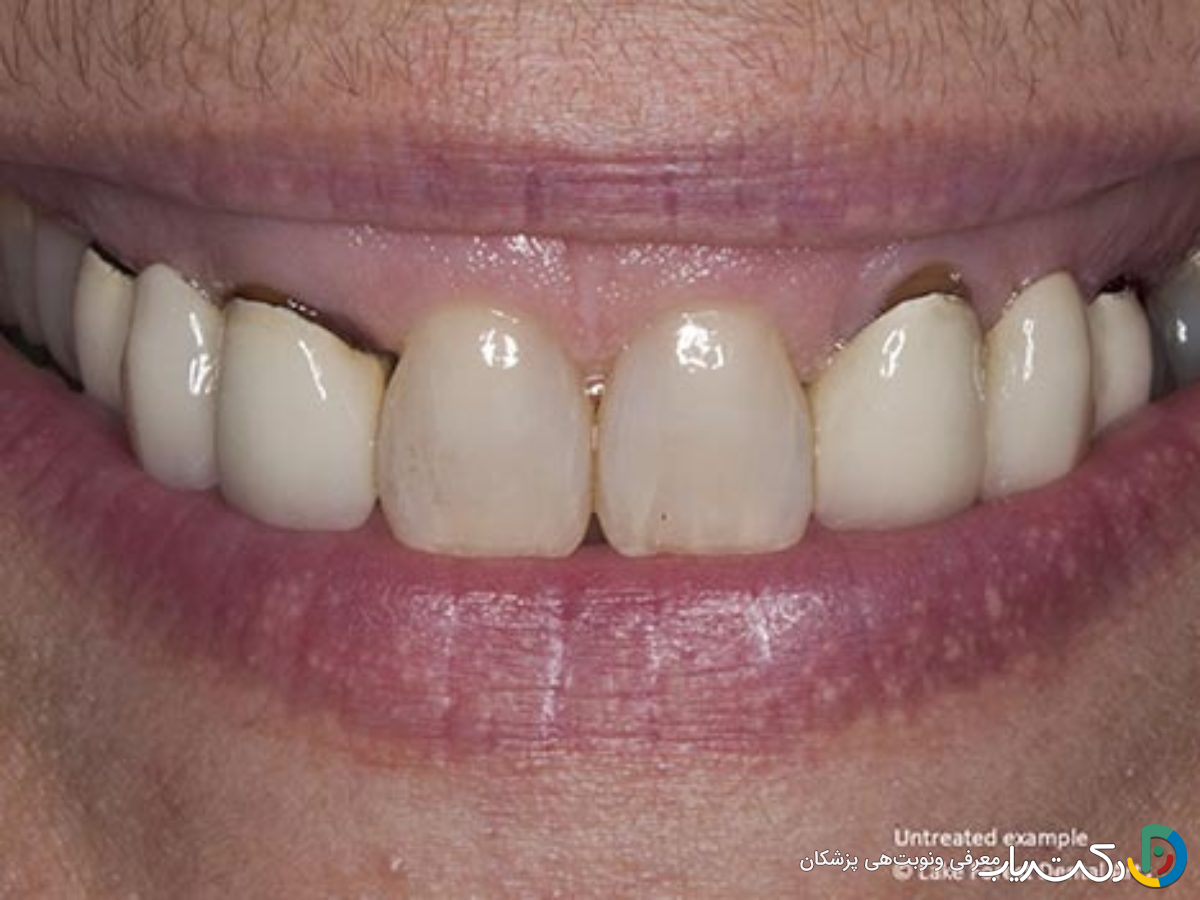 آیا روکش های PFM باعث سیاهی لثه می شوند؟