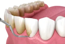 آیا دندان مصنوعی نیاز به جرم گیری دارد؟