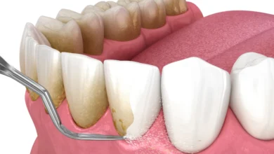 آیا دندان مصنوعی نیاز به جرم گیری دارد؟