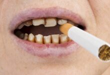 آیا بلیچینگ لکه های ناشی از سیگار را از بین می برد؟