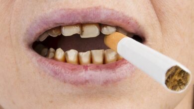 آیا بلیچینگ لکه های ناشی از سیگار را از بین می برد؟