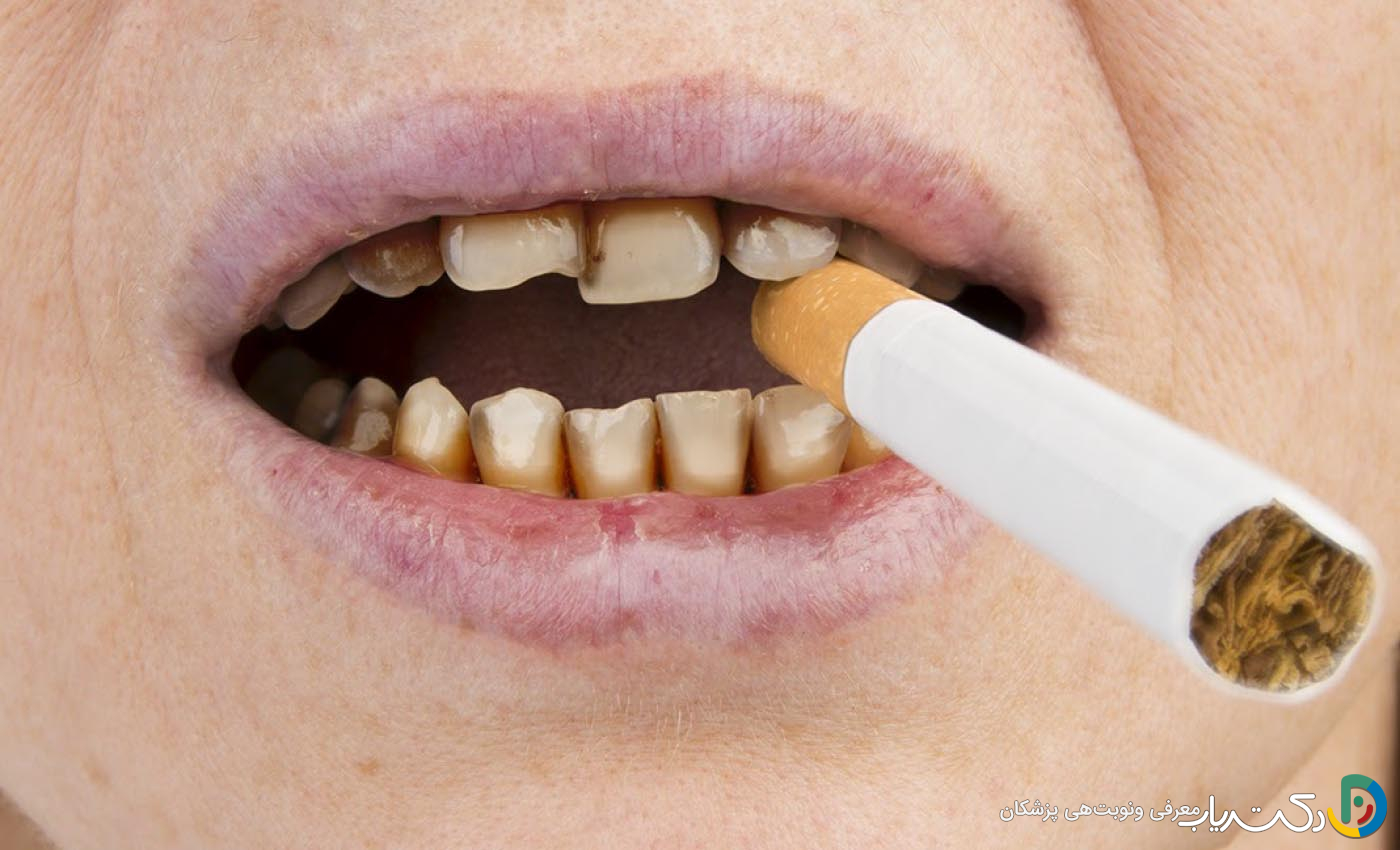 آیا بلیچینگ لکه های ناشی از سیگار را از بین می برد؟