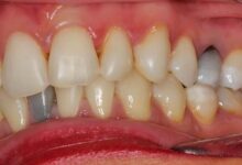 آیا بلیچینگ دندان های پر شده را سفید می کند؟