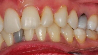 آیا بلیچینگ دندان های پر شده را سفید می کند؟