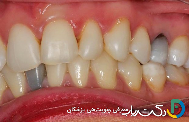 آیا بلیچینگ دندان های پر شده را سفید می کند؟