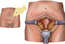 آیا بعد از عمل میومکتومی، زایمان حتما باید سزارین باشد؟