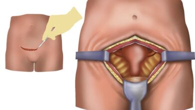 آیا بعد از عمل میومکتومی، زایمان حتما باید سزارین باشد؟