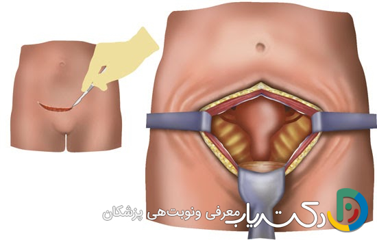 آیا بعد از عمل میومکتومی، زایمان حتما باید سزارین باشد؟