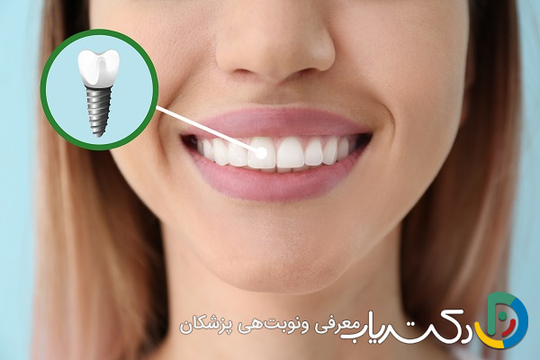 آیا ظاهر ایمپلنت با دندان طبیعی تفاوت دارد؟