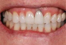 چگونه می توان از تحلیل لثه در اطراف ایمپلنت جلوگیری کرد؟
