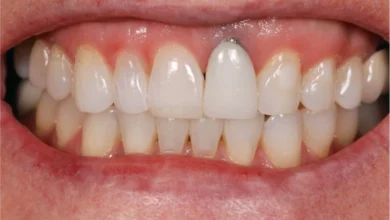 چگونه می توان از تحلیل لثه در اطراف ایمپلنت جلوگیری کرد؟