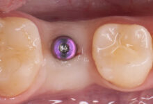 هیلینگ (Healing Abutment) چیست و چه کاربردی دارد؟