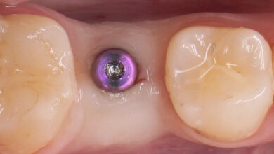 هیلینگ (Healing Abutment) چیست و چه کاربردی دارد؟