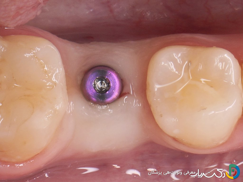 هیلینگ (Healing Abutment) چیست و چه کاربردی دارد؟