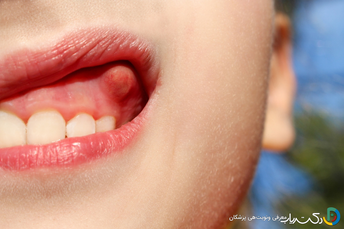 درمان خانگی آبسه دندان کودکان