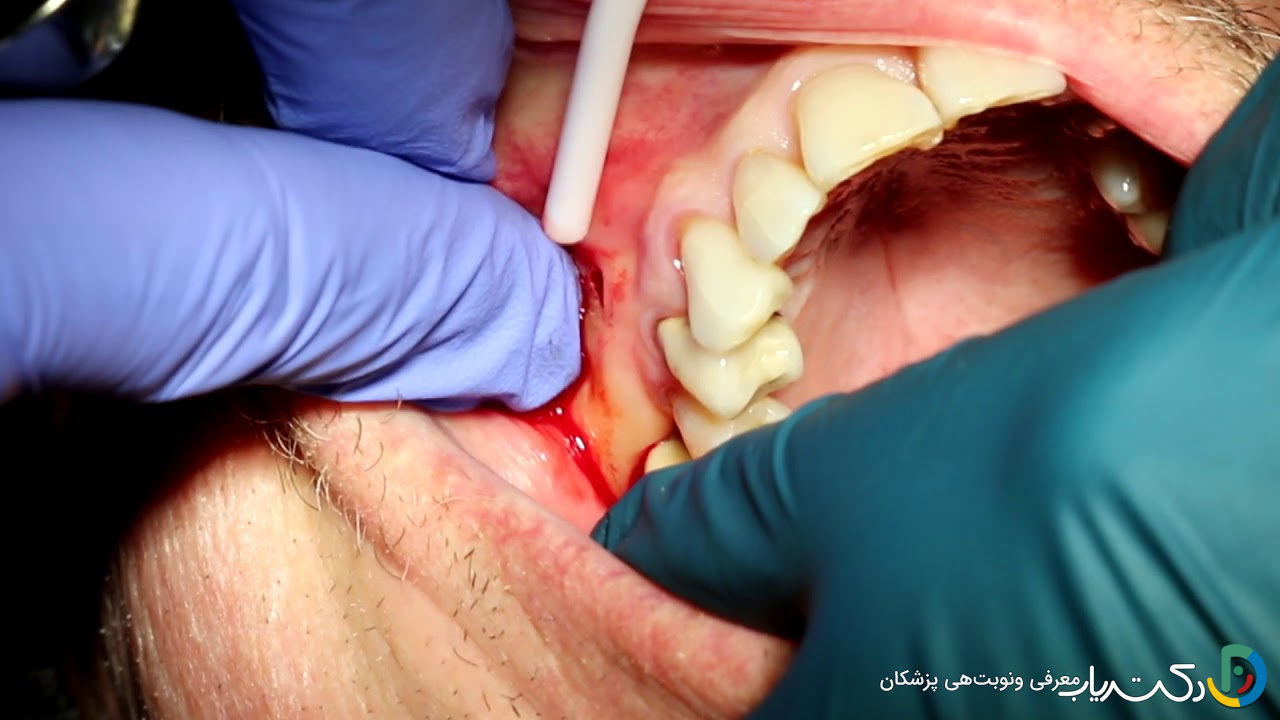نحوه تخلیه آبسه دندان چگونه است ؟