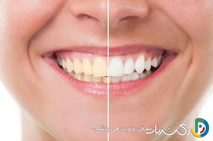 بلیچینگ در خانه چگونه انجام می شود؟