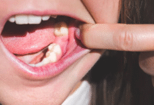 چه مدت بعد از کشیدن دندان می توان ایمپلنت کاشت؟