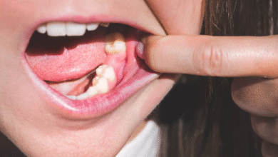 چه مدت بعد از کشیدن دندان می توان ایمپلنت کاشت؟