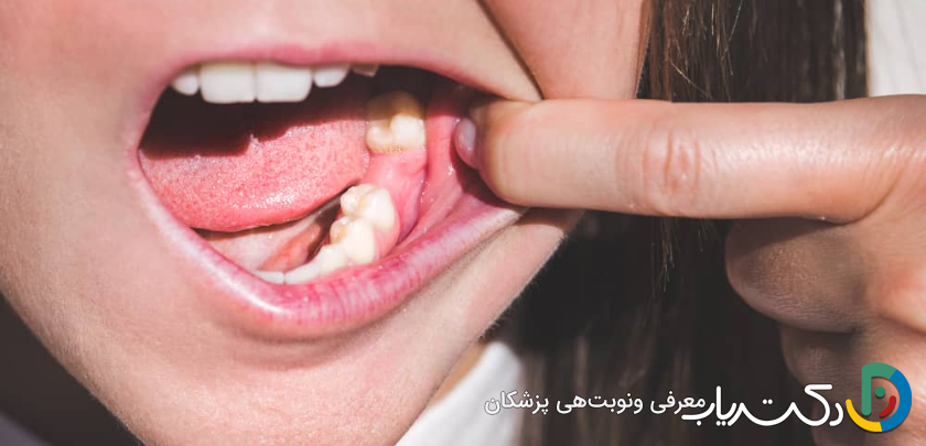 چه مدت بعد از کشیدن دندان می توان ایمپلنت کاشت؟