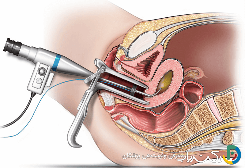 خونریزی بعد از هیستروسکوپی تا کی طبیعی است؟