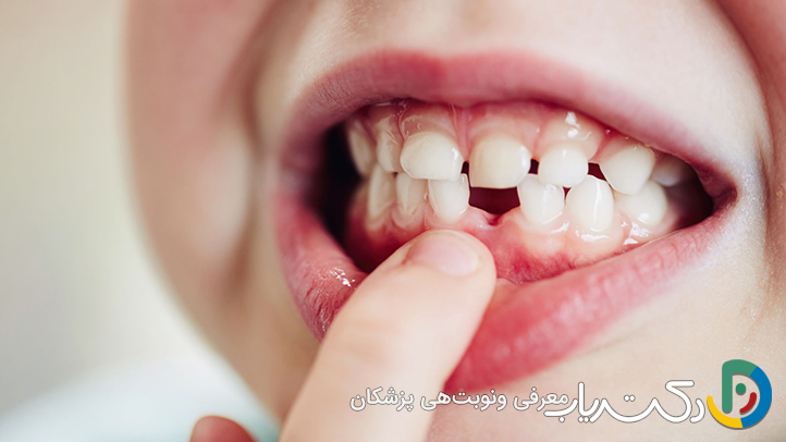 دندان شیری کودکان چند تاست و کی می افتد؟
