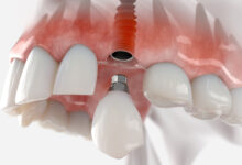 در هر جلسه جراحی چند ایمپلنت می توان کاشت؟