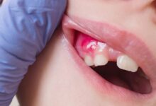 چگونه عفونت دندان را خارج کنیم؟