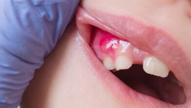 چگونه عفونت دندان را خارج کنیم؟