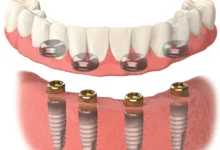 دندان مصنوعی بر پایه ایمپلنت اوردنچر چیست؟