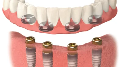 دندان مصنوعی بر پایه ایمپلنت اوردنچر چیست؟