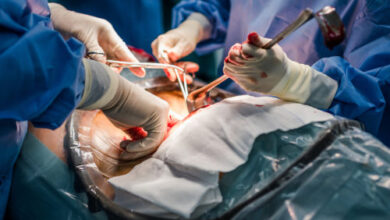 در چه مواردی سزارین انجام میشود؟ (دلایل پزشکی)