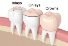اینله و انله Inlay & Onlay چیست و چه تفاوتی با پر کردن معمولی دارد؟