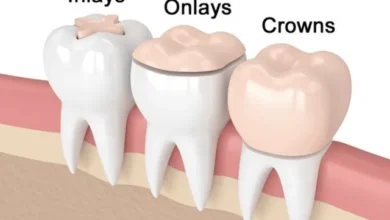 اینله و انله Inlay & Onlay چیست و چه تفاوتی با پر کردن معمولی دارد؟