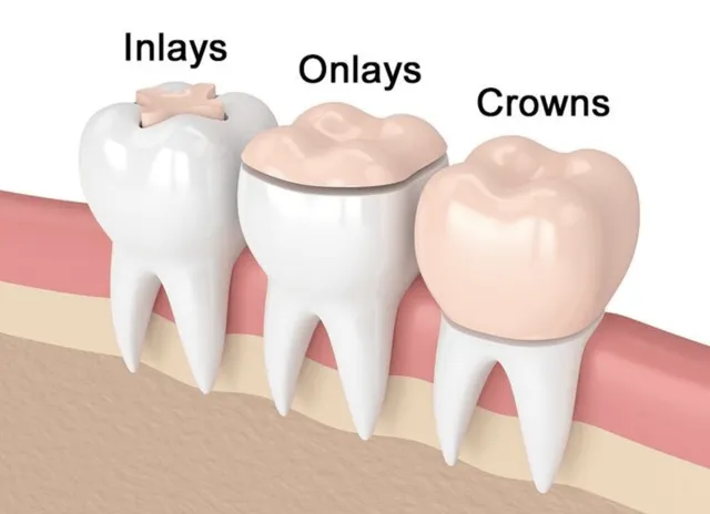 اینله و انله Inlay & Onlay چیست و چه تفاوتی با پر کردن معمولی دارد؟