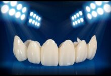 کامپوزیت دندان آمریکایی بهتر است یا ژاپنی؟