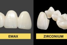 روکش ایمکس E max بهتر است یا زیرکونیا؟