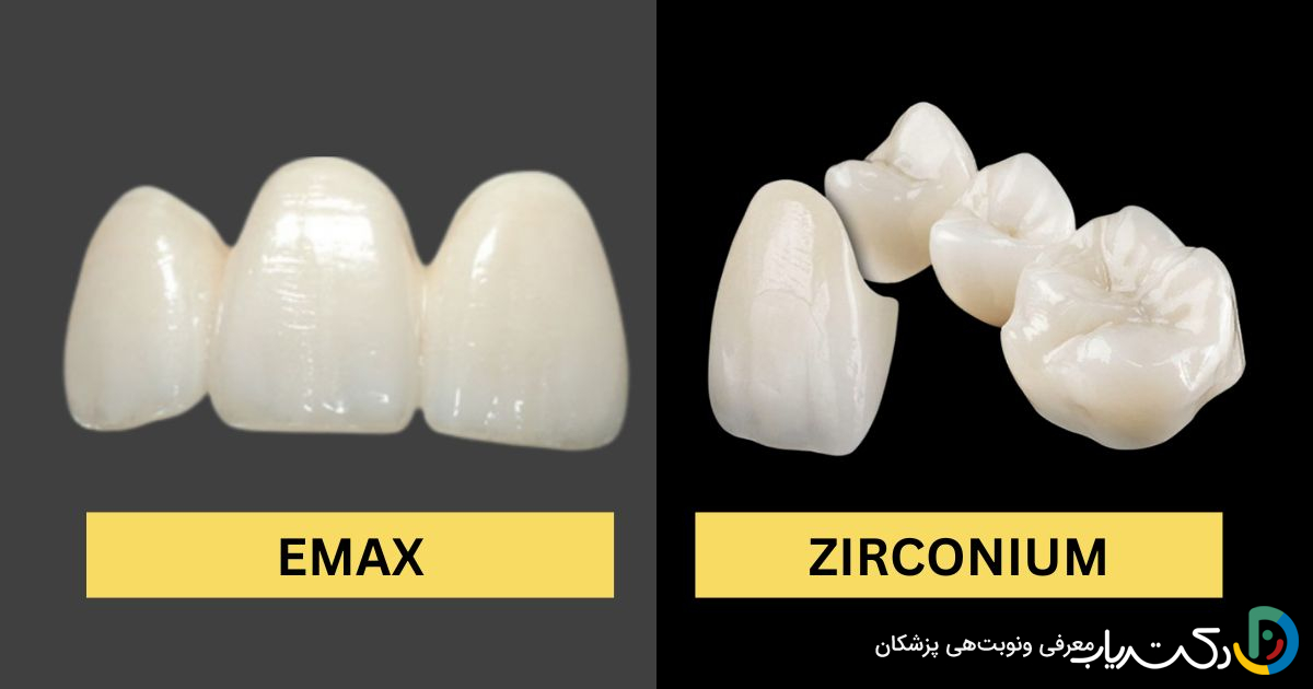 روکش ایمکس E max بهتر است یا زیرکونیا؟