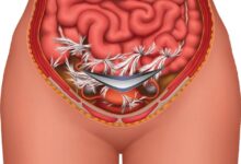 آیا هیسترکتومی دردناک است؟