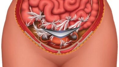 آیا هیسترکتومی دردناک است؟