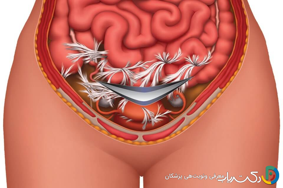 آیا هیسترکتومی دردناک است؟