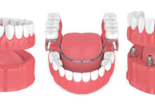 برای یک یا دو دندان کشیده شده، دندان مصنوعی تکه ای بهتر است یا ایمپلنت؟