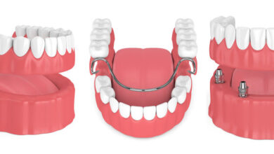 برای یک یا دو دندان کشیده شده، دندان مصنوعی تکه ای بهتر است یا ایمپلنت؟