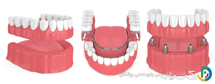 برای یک یا دو دندان کشیده شده، دندان مصنوعی تکه ای بهتر است یا ایمپلنت؟
