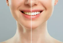 برای سفید کردن، بلیچینگ بهتر است یا جرمگیری؟
