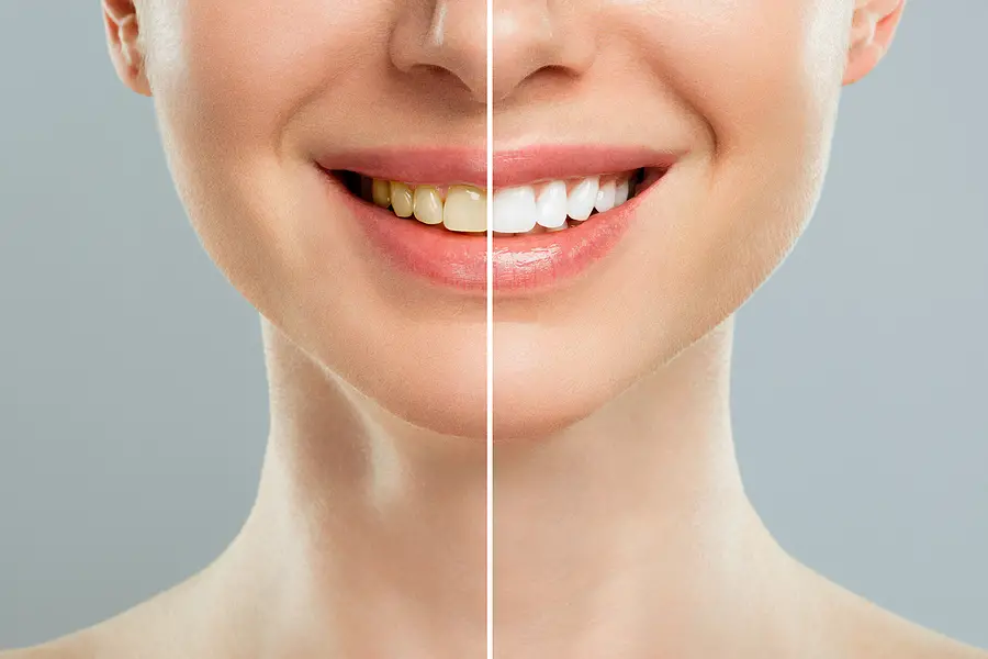 برای سفید کردن، بلیچینگ بهتر است یا جرمگیری؟