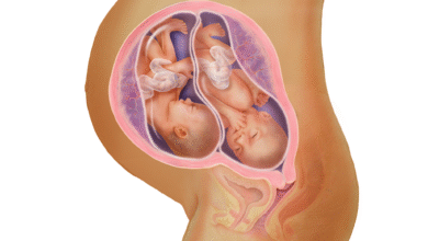 آیا در بارداری دوقلو هم سرکلاژ انجام میشود؟