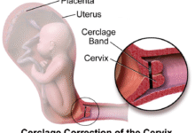 آیا عمل سرکلاژ درد دارد؟