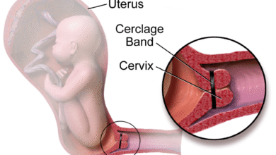 آیا عمل سرکلاژ درد دارد؟